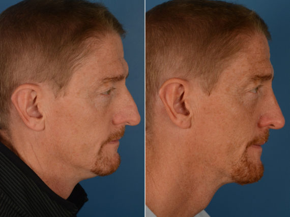 Rhinoplasty Before and After Photos in Naples, FL, Patient 12968