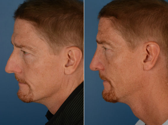 Rhinoplasty Before and After Photos in Naples, FL, Patient 12968