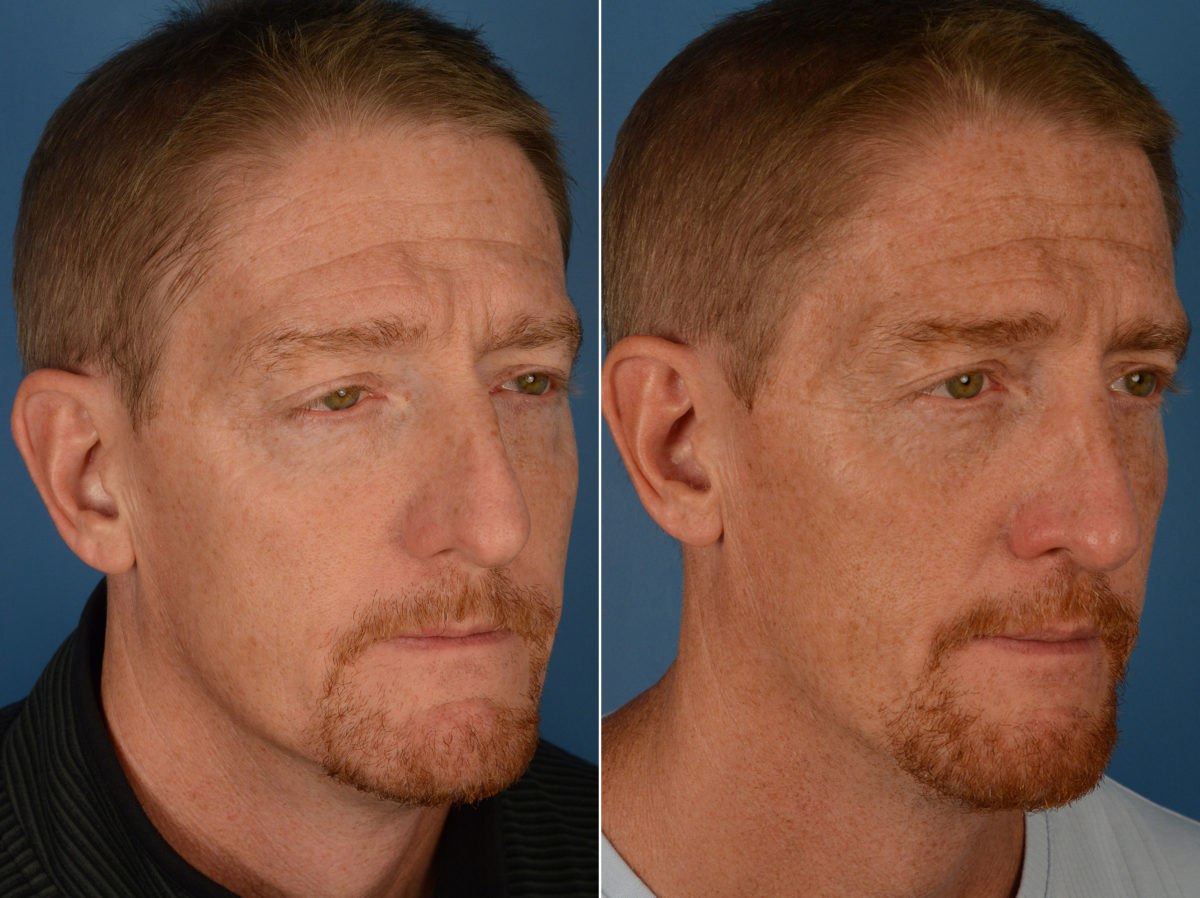 Rhinoplasty Before and After Photos in Naples, FL, Patient 12968