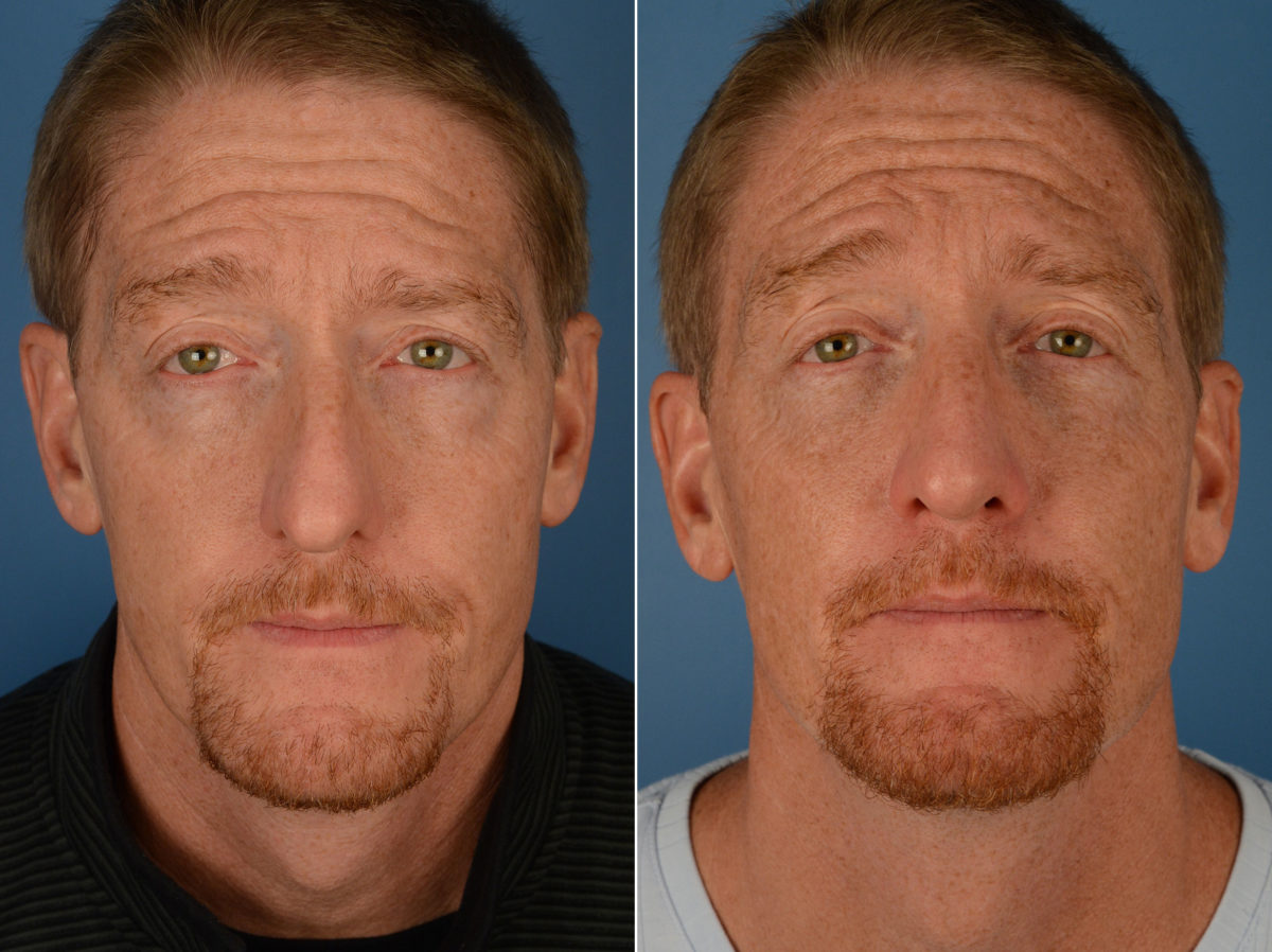 Rhinoplasty Before and After Photos in Naples, FL, Patient 12968