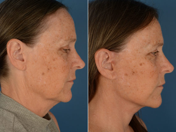 The UpLift™ Lower Face and Neck Lift Before and After Photos in Naples, FL, Patient 13162