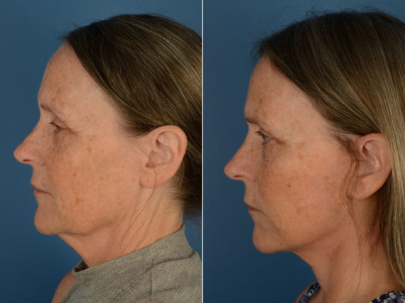 The UpLift™ Lower Face and Neck Lift Before and After Photos in Naples, FL, Patient 13162