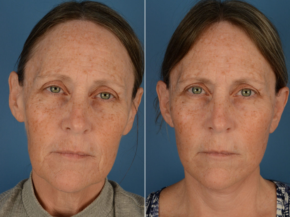 The UpLift™ Lower Face and Neck Lift Before and After Photos in Naples, FL, Patient 13162
