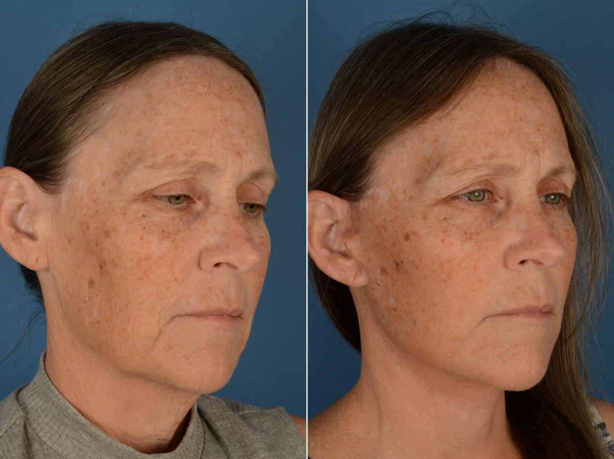 The UpLift™ Lower Face and Neck Lift Before and After Photos in Naples, FL, Patient 13162