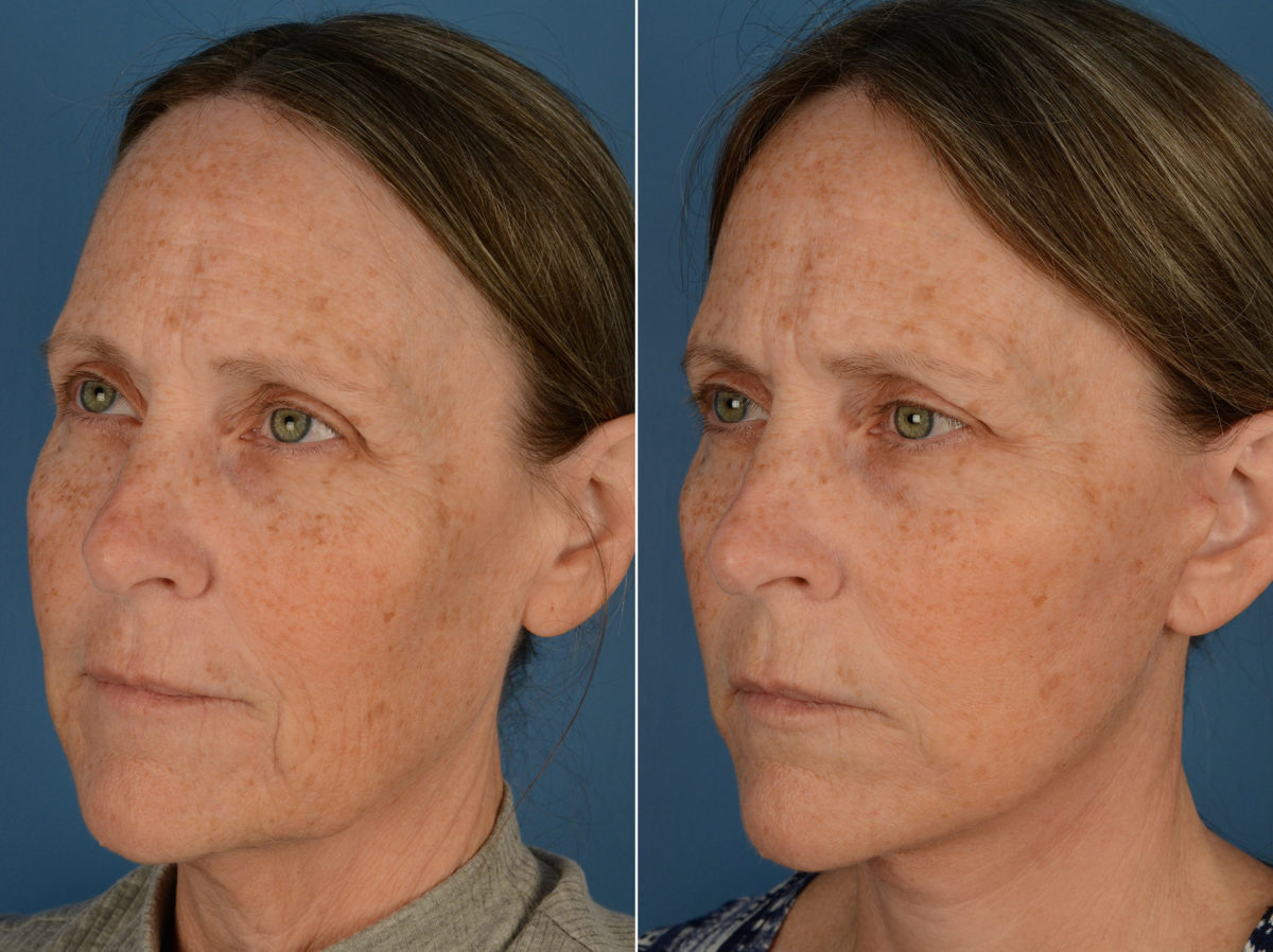 The UpLift™ Lower Face and Neck Lift Before and After Photos in Naples, FL, Patient 13162