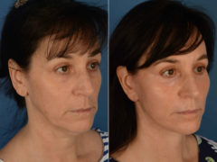 The UpLift™ Lower Face and Neck Lift Before and After Photos in Naples, FL, Patient 13339