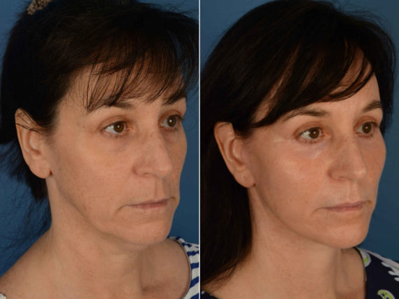 Fat Transfer Before and After Photos in Naples, FL, Patient 13339