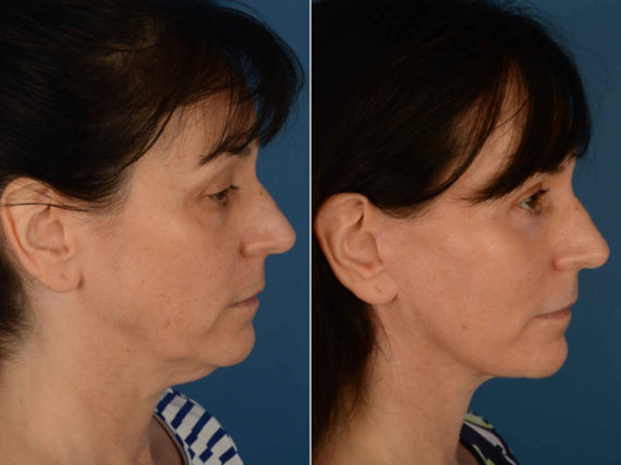 The UpLift™ Lower Face and Neck Lift Before and After Photos in Naples, FL, Patient 13339