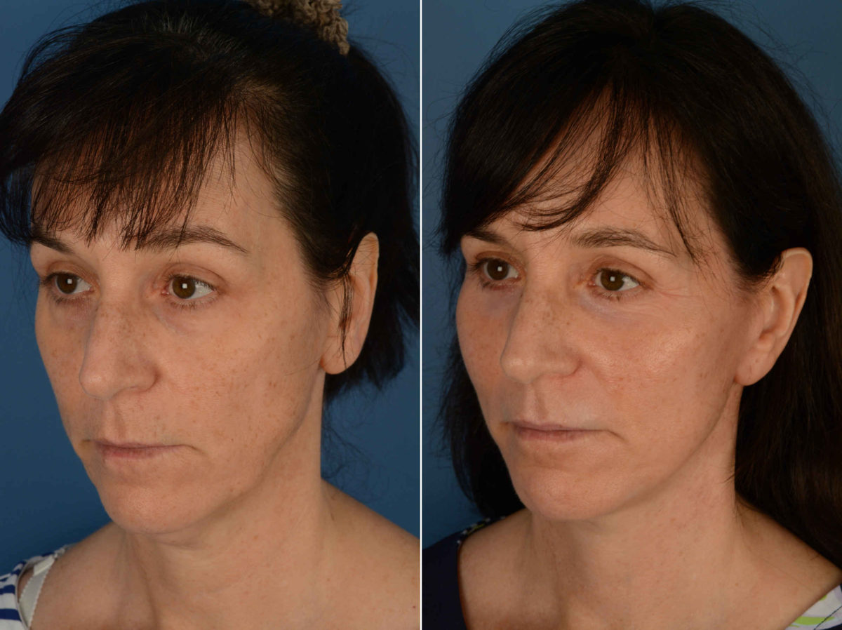 Fat Transfer Before and After Photos in Naples, FL, Patient 13339