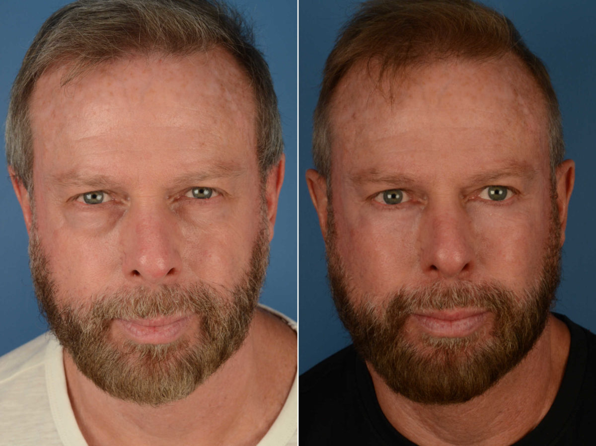 Blepharoplasty Before and After Photos in Naples, FL, Patient 13453