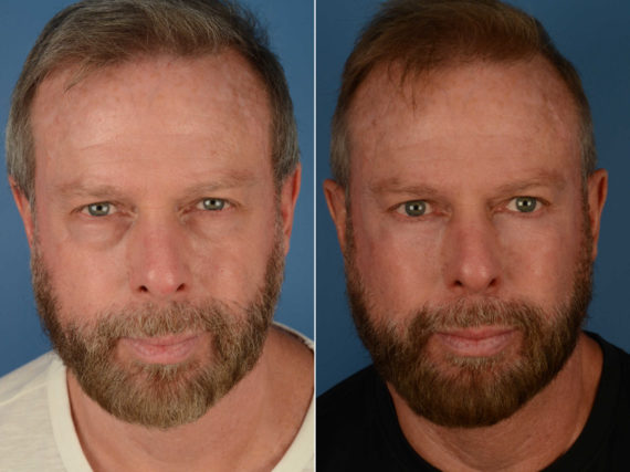 Blepharoplasty Before and After Photos in Naples, FL, Patient 13453