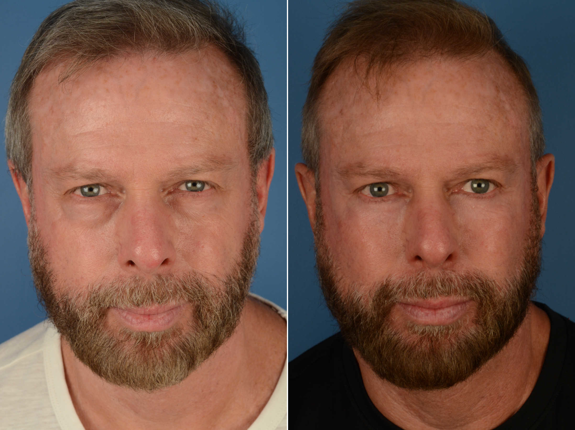 Blepharoplasty Photos Naples Fl Patient 13453