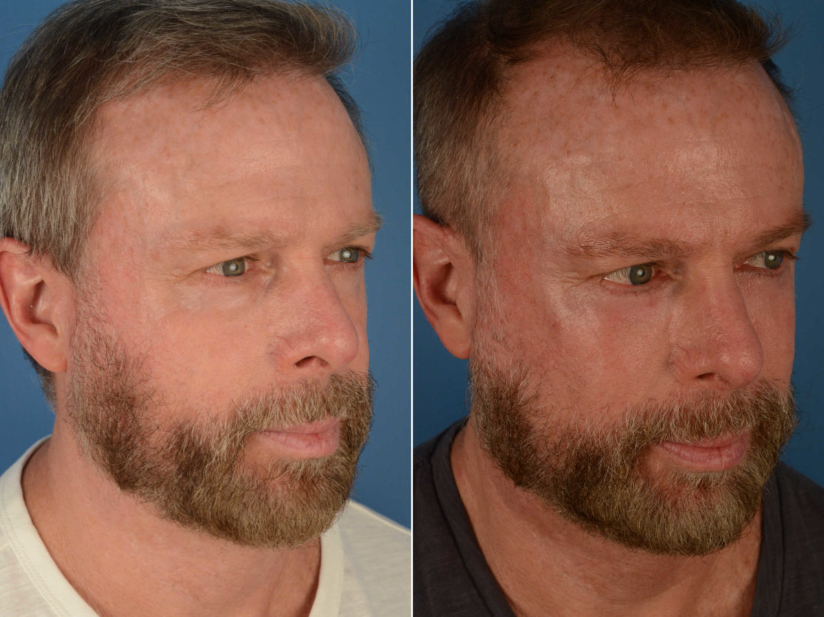 Blepharoplasty Before and After Photos in Naples, FL, Patient 13453