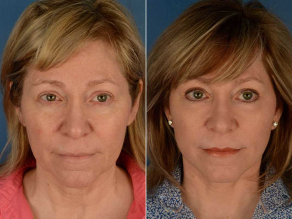 The UpLift™ Lower Face and Neck Lift Before and After Photos in Naples, FL, Patient 13540