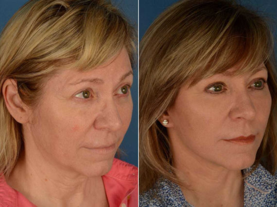 The UpLift™ Lower Face and Neck Lift Before and After Photos in Naples, FL, Patient 13540