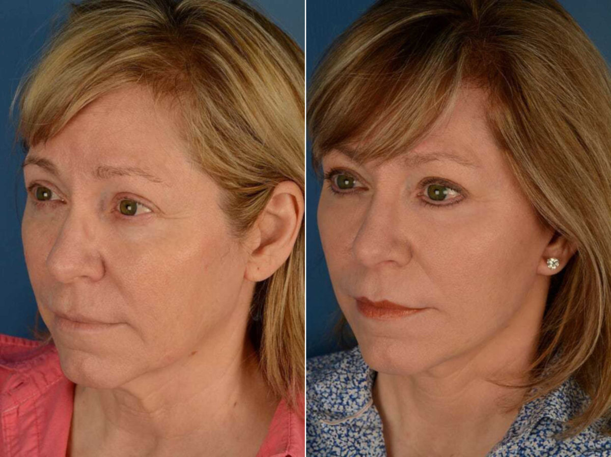 The UpLift™ Lower Face and Neck Lift Before and After Photos in Naples, FL, Patient 13540
