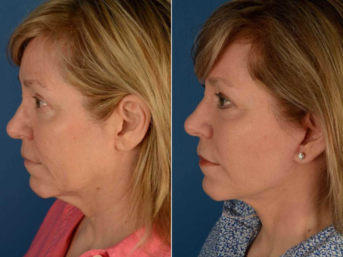 The UpLift™ Lower Face and Neck Lift Before and After Photos in Naples, FL, Patient 13540
