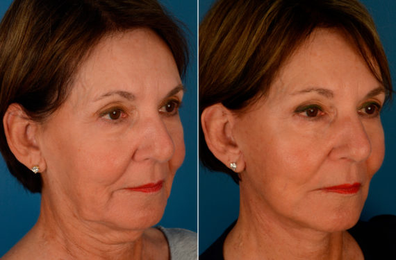 The UpLift™ Lower Face and Neck Lift Before and After Photos in Naples, FL, Patient 13692