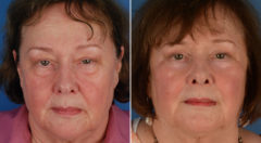 Blepharoplasty Before and After Photos in Naples, FL, Patient 11663