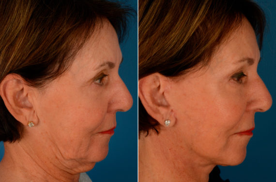 The UpLift™ Lower Face and Neck Lift Before and After Photos in Naples, FL, Patient 13692