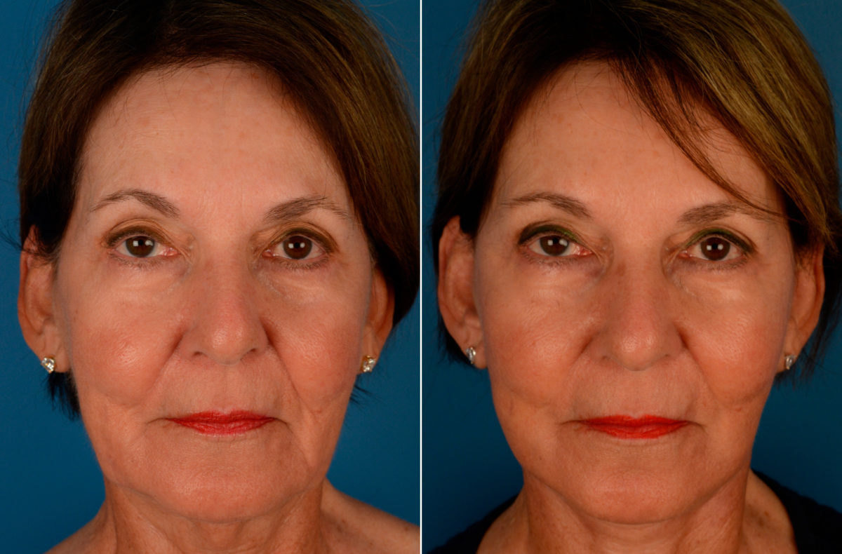 The UpLift™ Lower Face and Neck Lift Before and After Photos in Naples, FL, Patient 13692