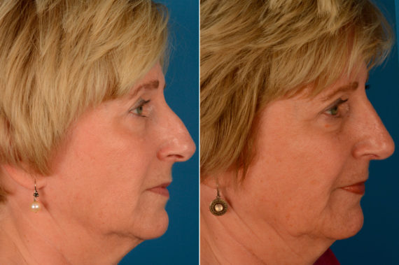 Rhinoplasty Before and After Photos in Naples, FL, Patient 13845