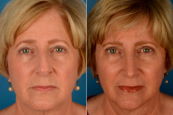 Rhinoplasty Before and After Photos in Naples, FL, Patient 13845