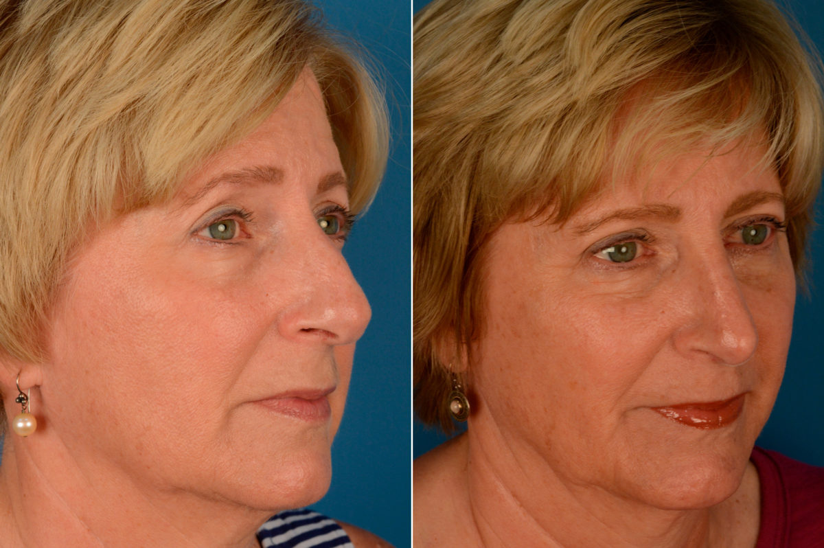 Rhinoplasty Before and After Photos in Naples, FL, Patient 13845