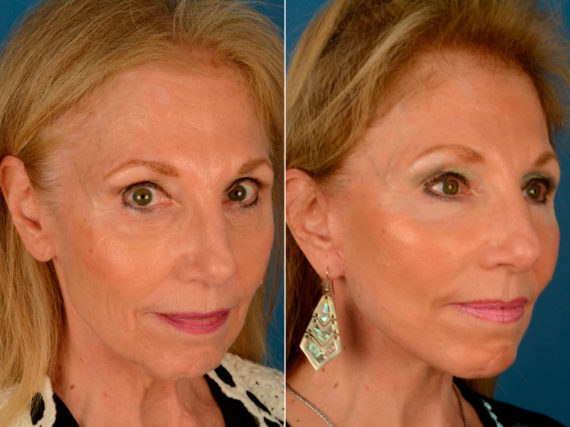 The UpLift™ Lower Face and Neck Lift Before and After Photos in Naples, FL, Patient 13940