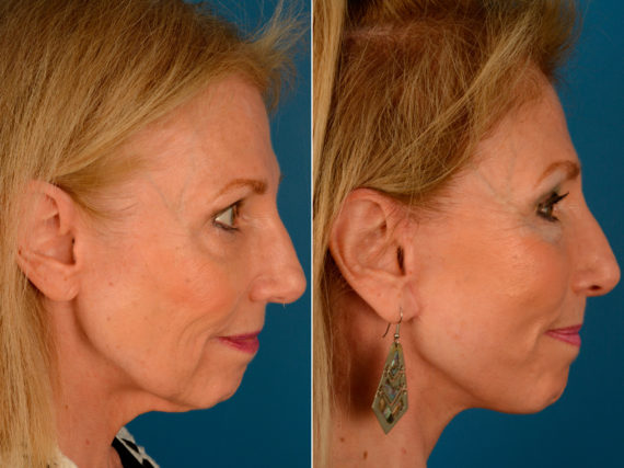 The UpLift™ Lower Face and Neck Lift Before and After Photos in Naples, FL, Patient 13940