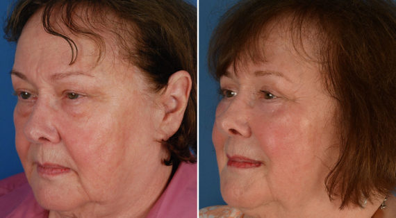 Blepharoplasty Before and After Photos in Naples, FL, Patient 11663