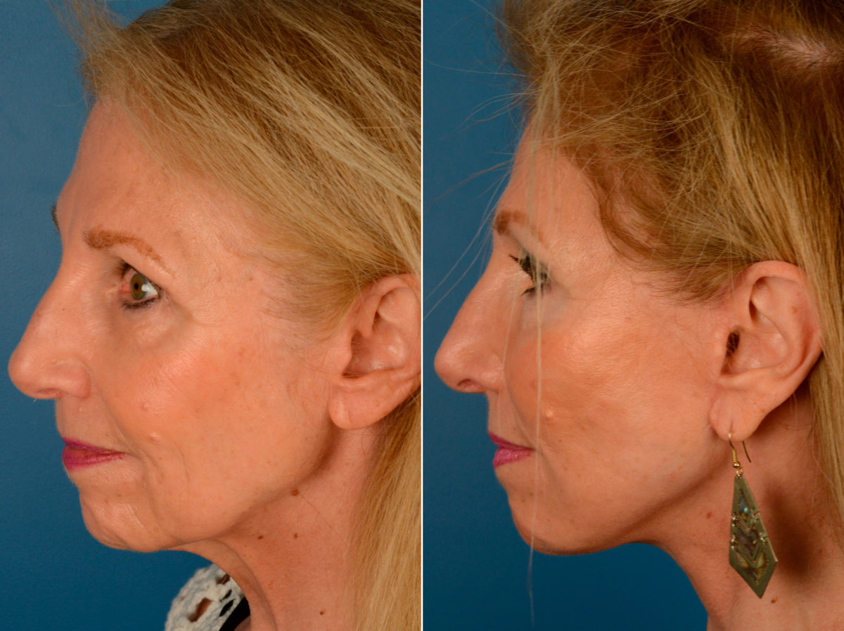 The UpLift™ Lower Face and Neck Lift Before and After Photos in Naples, FL, Patient 13940