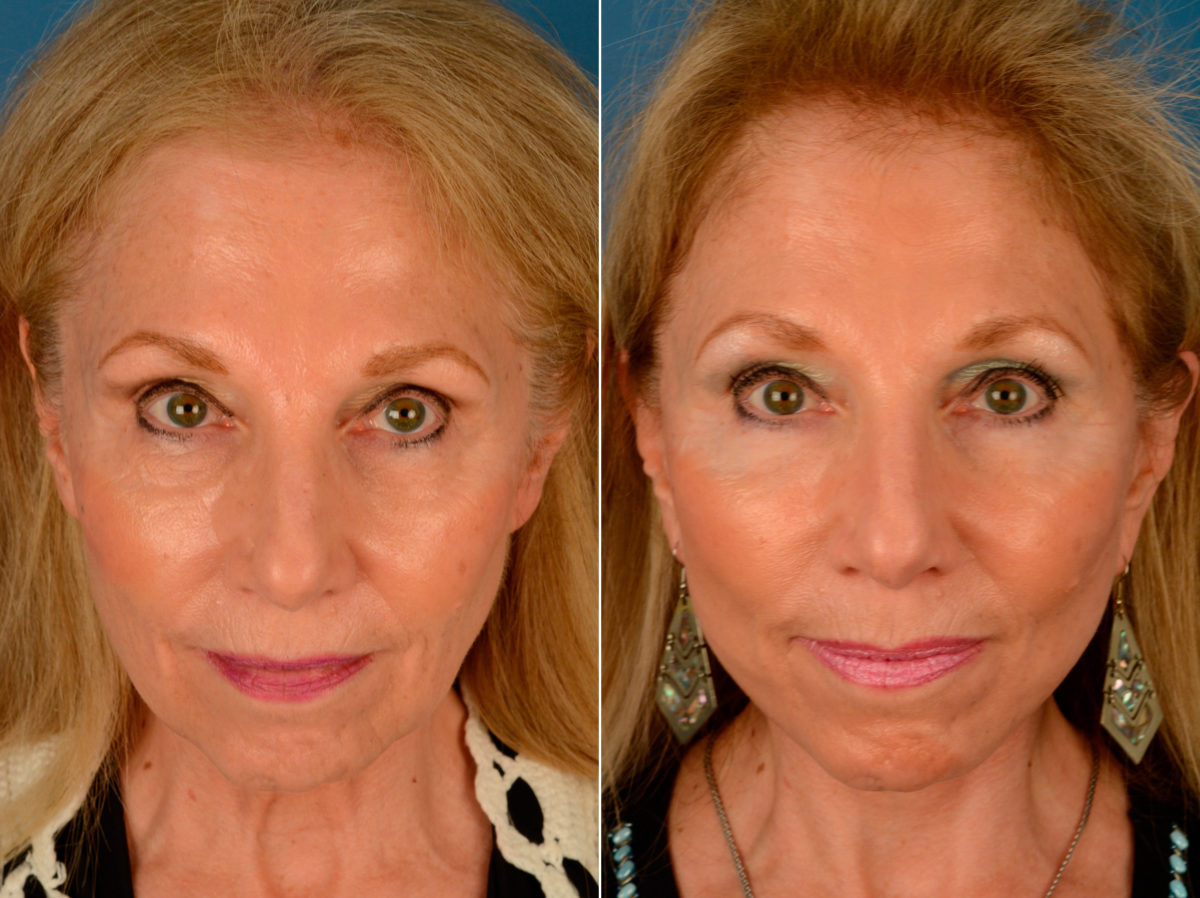 The UpLift™ Lower Face and Neck Lift Before and After Photos in Naples, FL, Patient 13940