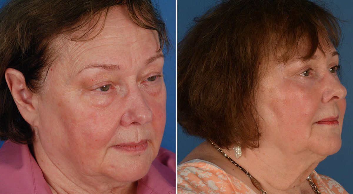 Blepharoplasty Before and After Photos in Naples, FL, Patient 11663