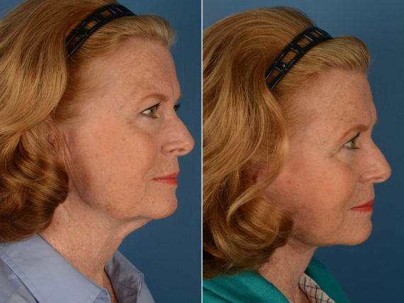 The UpLift™ Lower Face and Neck Lift Before and After Photos in Naples, FL, Patient 14031