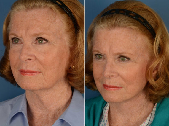 The UpLift™ Lower Face and Neck Lift Before and After Photos in Naples, FL, Patient 14031