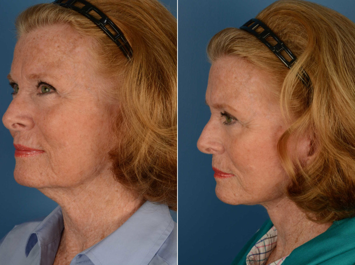 The UpLift™ Lower Face and Neck Lift Before and After Photos in Naples, FL, Patient 14031