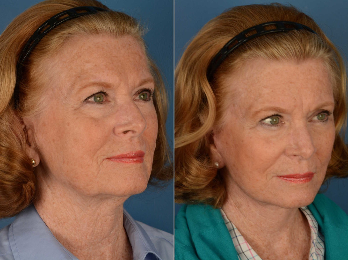 The UpLift™ Lower Face and Neck Lift Before and After Photos in Naples, FL, Patient 14031