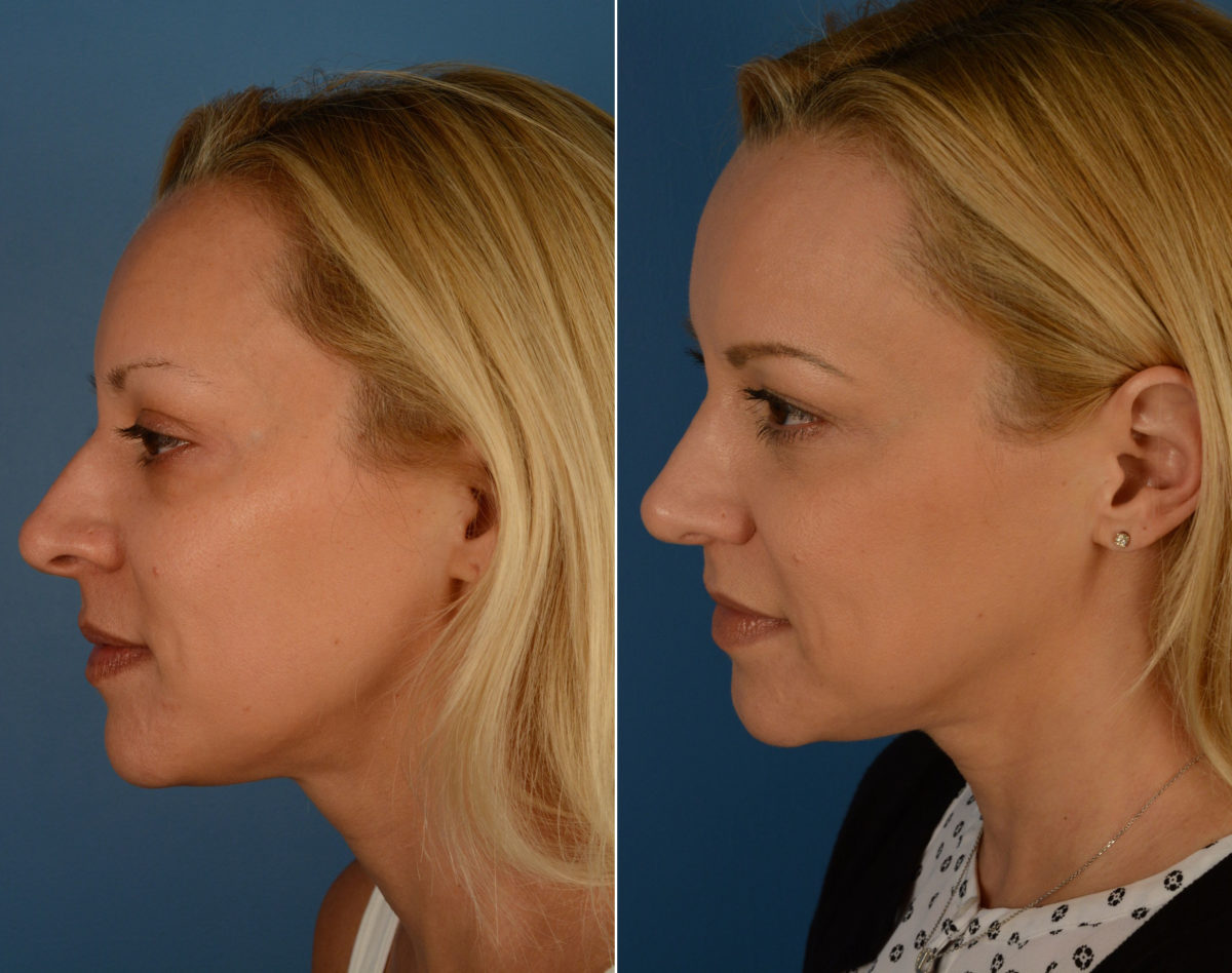 Rhinoplasty Before and After Photos in Naples, FL, Patient 14162