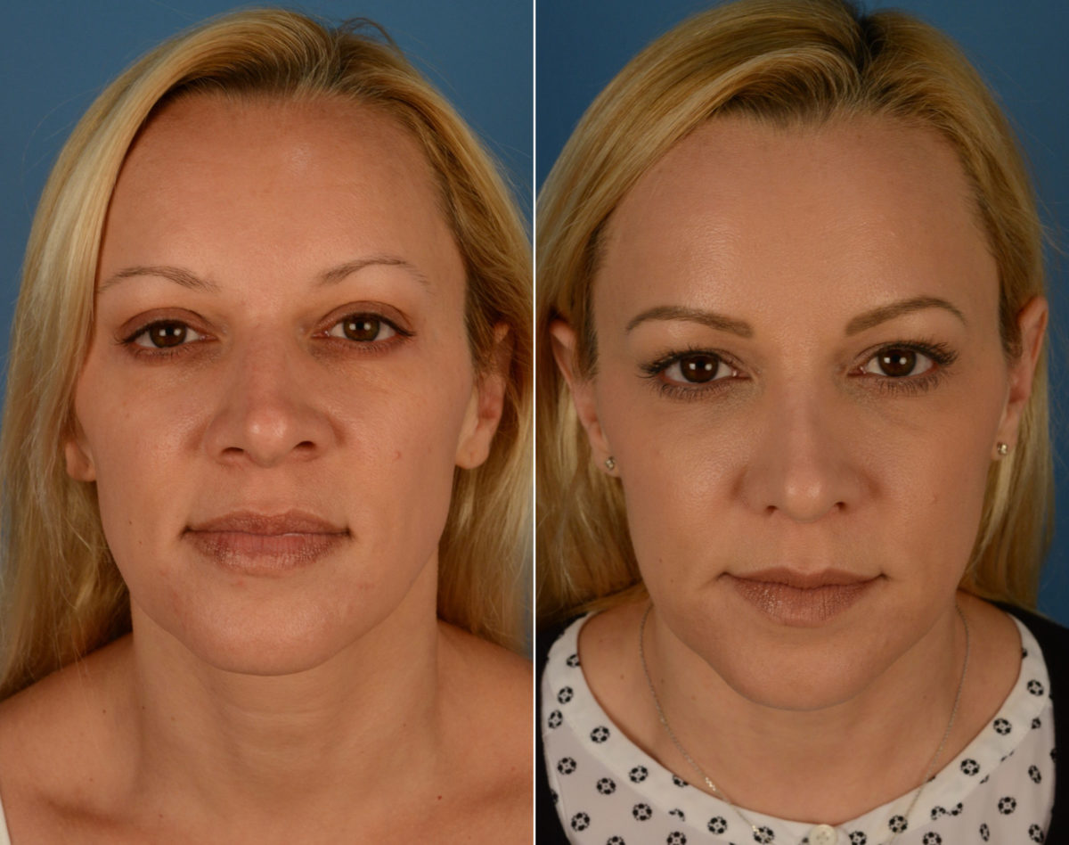 Rhinoplasty Before and After Photos in Naples, FL, Patient 14162