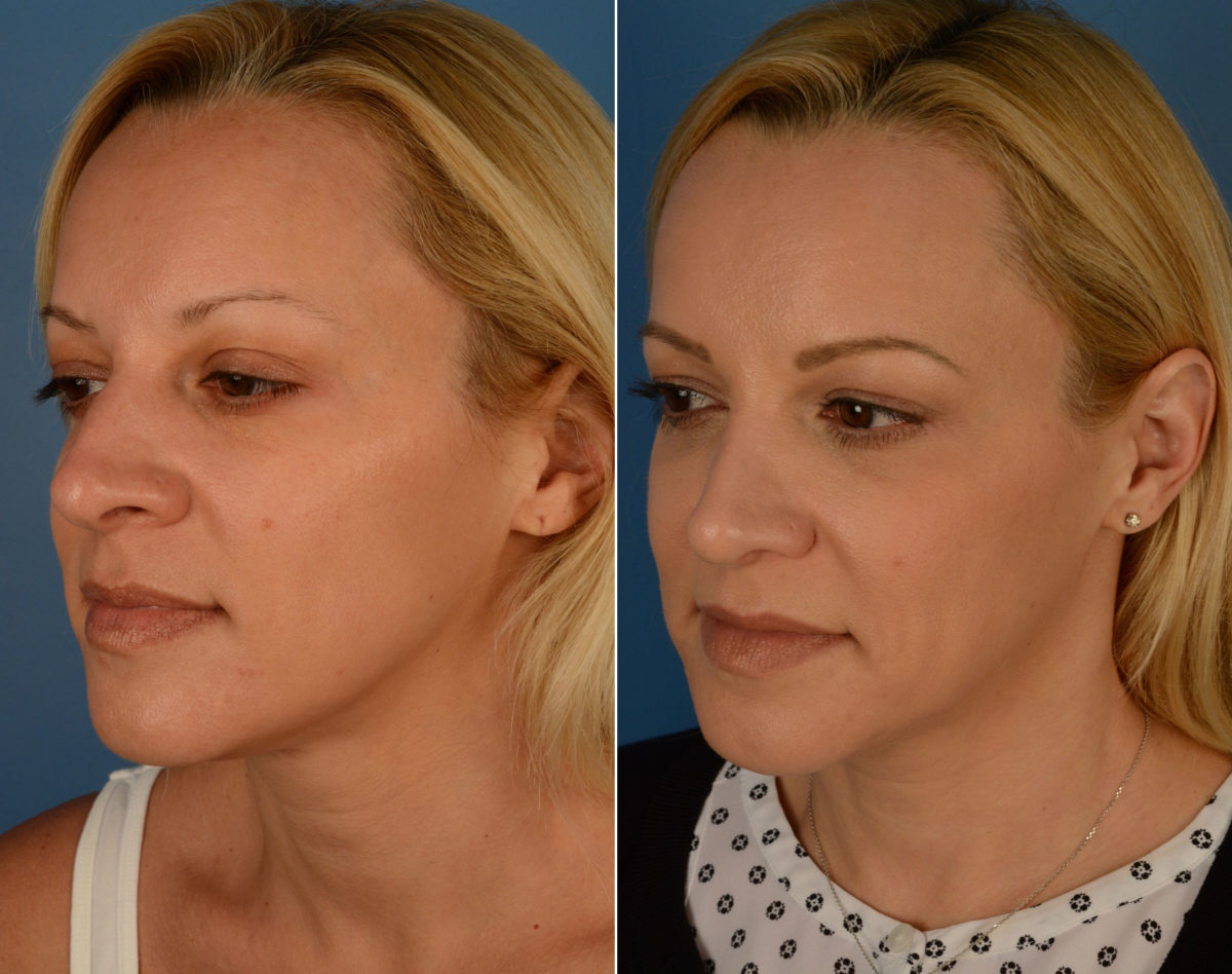 Rhinoplasty Before and After Photos in Naples, FL, Patient 14162