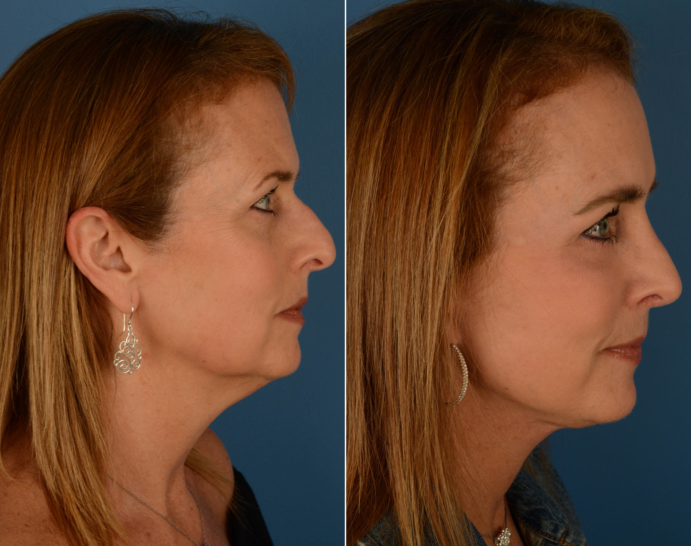 The Uplift™ Lower Face And Neck Lift Photos Naples Fl Patient 14192