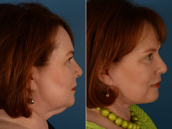 The UpLift™ Lower Face and Neck Lift Before and After Photos in Naples, FL, Patient 14344