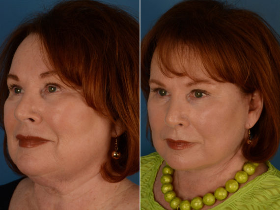 The UpLift™ Lower Face and Neck Lift Before and After Photos in Naples, FL, Patient 14344