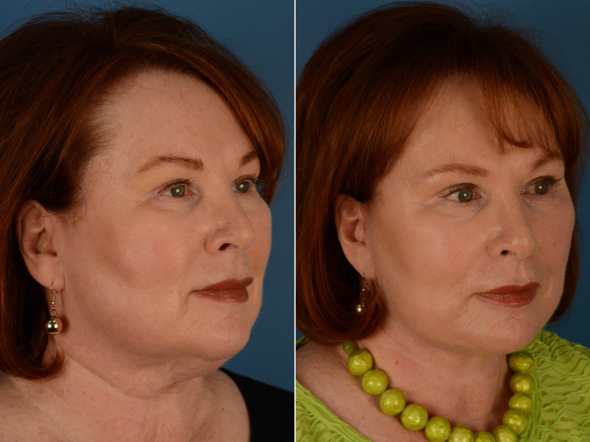 The UpLift™ Lower Face and Neck Lift Before and After Photos in Naples, FL, Patient 14344
