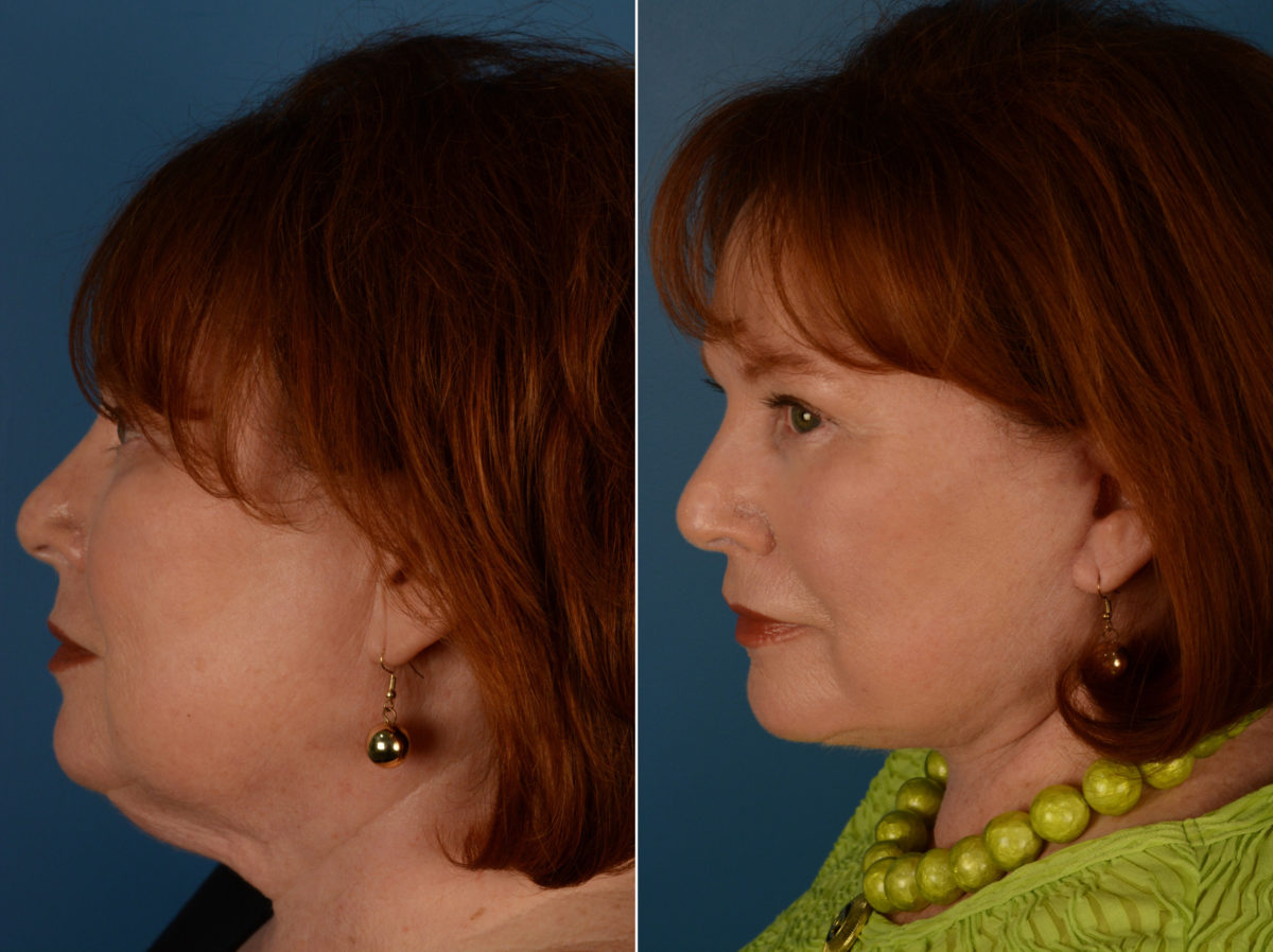 The UpLift™ Lower Face and Neck Lift Before and After Photos in Naples, FL, Patient 14344