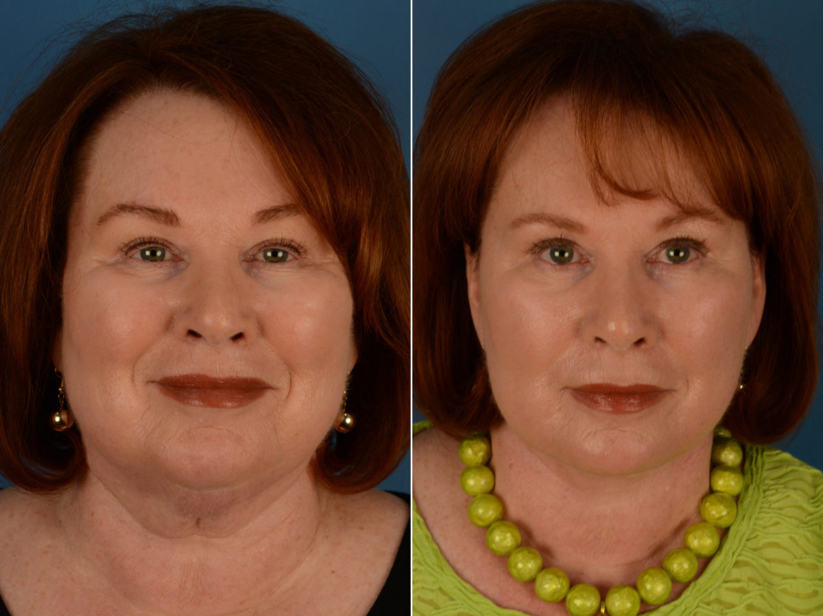 The UpLift™ Lower Face and Neck Lift Before and After Photos in Naples, FL, Patient 14344