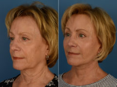 Fat Transfer Before and After Photos in Naples, FL, Patient 14406