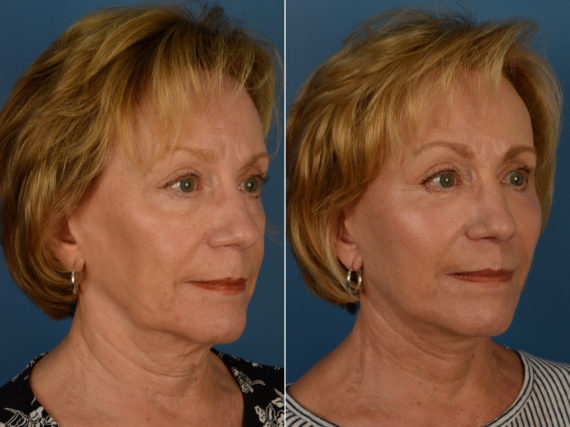 Fat Transfer Before and After Photos in Naples, FL, Patient 14406