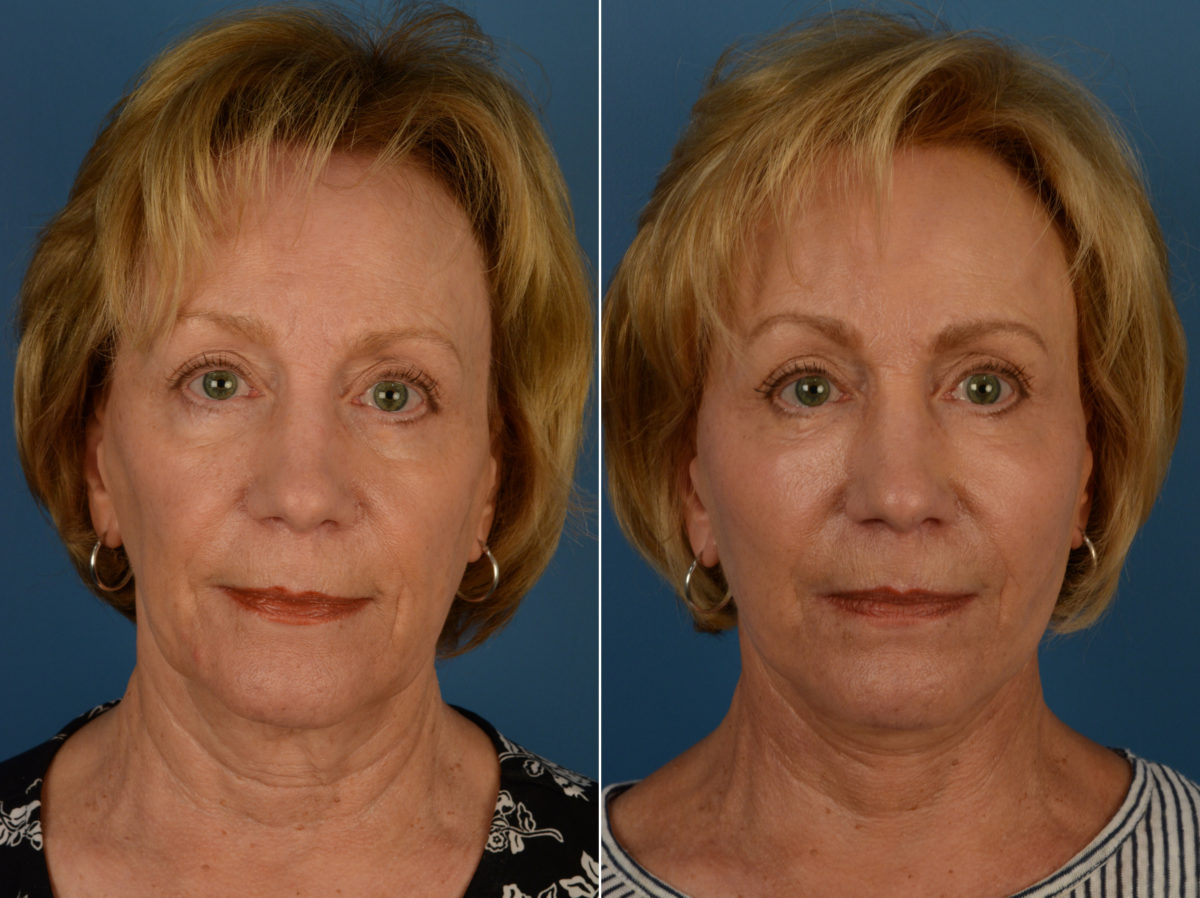Fat Transfer Before and After Photos in Naples, FL, Patient 14406